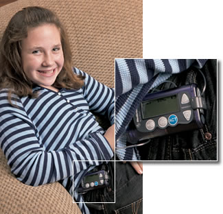 diabetes-insulin-pump